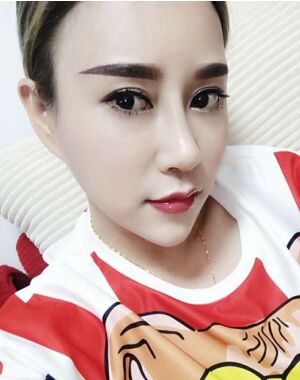 牛永敢做的隆鼻失敗修復(fù)，對(duì)比很明X哦~