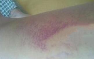 水動(dòng)力吸脂減肥瘦大腿前面一周恢復(fù)過(guò)程有些辛苦