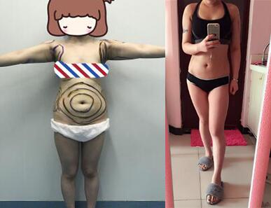 吸脂減肥瘦腰腹+手臂術后果對比圖