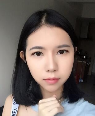 自體脂肪填充恢復日志 自體脂肪填充太陽穴+額頭