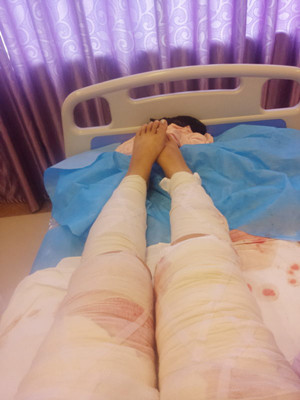 水動力吸脂瘦大腿后瘦了不止一點點