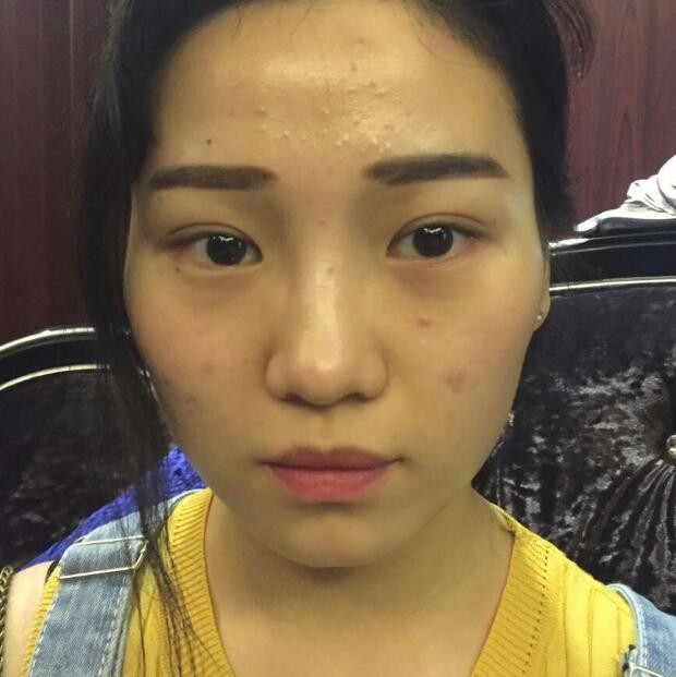 玻尿酸墊下巴手術(shù)恢復全過程圖片分享