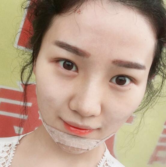 玻尿酸墊下巴手術(shù)恢復全過程圖片分享