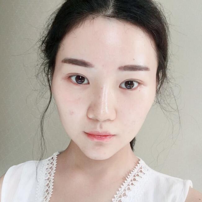 玻尿酸墊下巴手術(shù)恢復全過程圖片分享