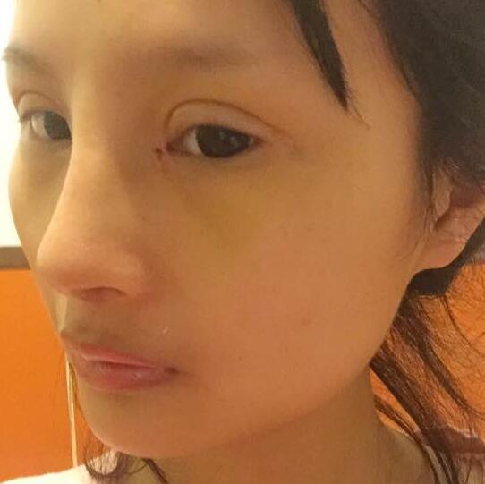 自體脂肪隆鼻+割雙眼皮的恢復過程讓我找到了自信