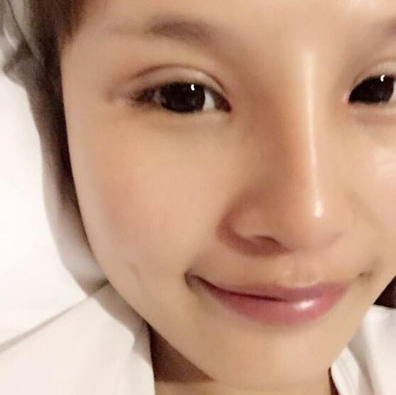 自體脂肪隆鼻+割雙眼皮的恢復過程讓我找到了自信