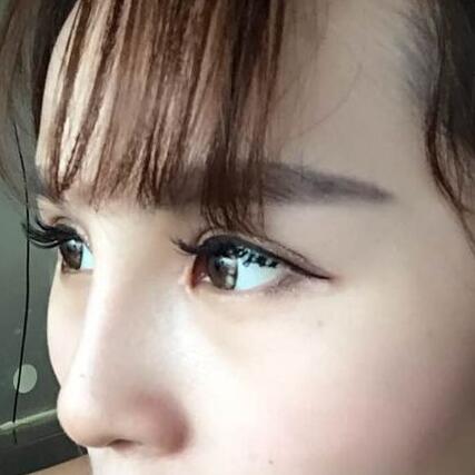 自體脂肪隆鼻+割雙眼皮的恢復過程讓我找到了自信