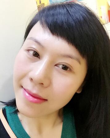 面部埋埋蛋白線.提升恢復(fù)過(guò)程分享