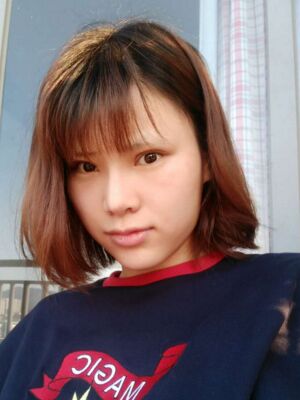 隆鼻整形真實恢復(fù)期圖片，大鼻子終于變秀氣了