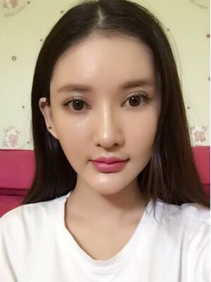 面部埋埋蛋白線.提升術(shù)后照片，皮膚緊致不少了