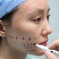 蛋白線面部埋埋蛋白線.提升手術(shù)價格15000元，果不錯分享給大家