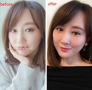 面部埋埋蛋白線.提升手術(shù)