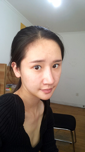 56000元做的自體脂肪填充蘋果肌+太陽穴，大家來看看果怎么樣