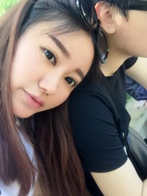 雙眼皮失敗修復(fù)手術(shù)恢復(fù)前后對比圖