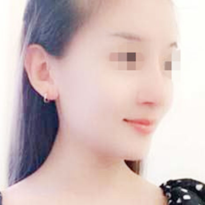 上海九院戴傳昌硅膠假體隆鼻案例