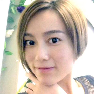 上海九院戴傳昌玻尿酸注射隆鼻和墊下巴案例