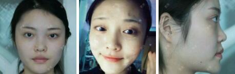 假體隆鼻15天后恢復(fù)圖，隆鼻果自然