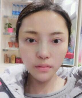 假體隆鼻15天后恢復(fù)圖，隆鼻果自然