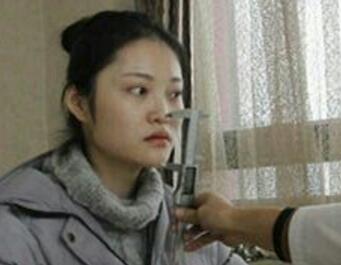 假體隆鼻15天后恢復(fù)圖，隆鼻果自然