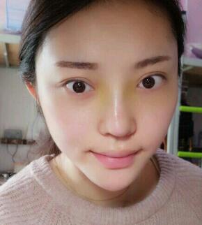 假體隆鼻15天后恢復(fù)圖，隆鼻果自然