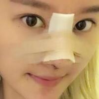 硅膠假體隆鼻過程和隆鼻前后圖片，真實案例分享