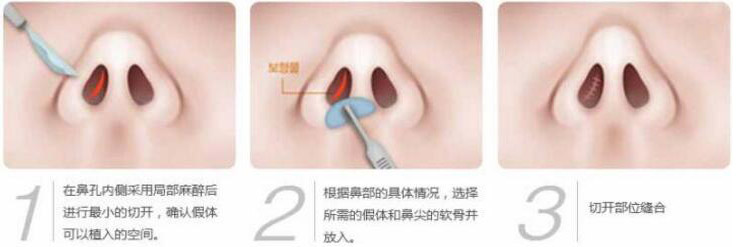 硅膠假體隆鼻過程和隆鼻前后圖片，真實案例分享