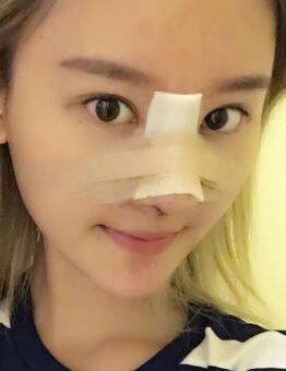 硅膠假體隆鼻過程和隆鼻前后圖片，真實案例分享