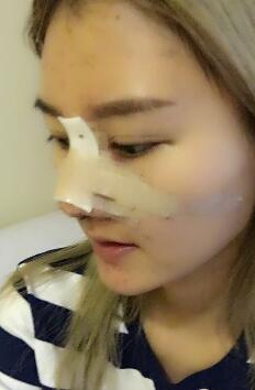 硅膠假體隆鼻過程和隆鼻前后圖片，真實案例分享