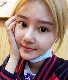 硅膠假體隆鼻過程和隆鼻前后圖片，真實案例分享