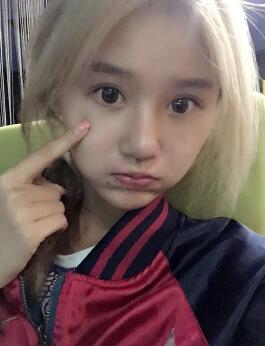 硅膠假體隆鼻過程和隆鼻前后圖片，真實案例分享