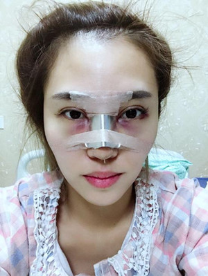 長沙華韓華美做的隆鼻整形，感覺果還不錯哦!