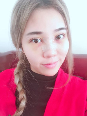 長沙華韓華美做的隆鼻整形，感覺果還不錯哦!