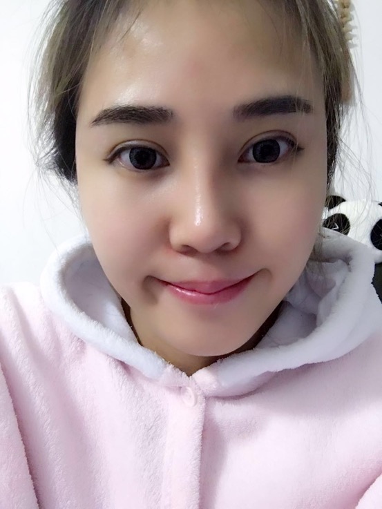 長沙華韓華美做的隆鼻整形，感覺果還不錯哦!