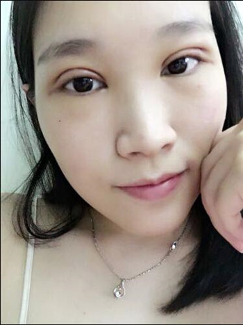 做全切雙眼皮花了8000多 整體恢復(fù)果真的很棒