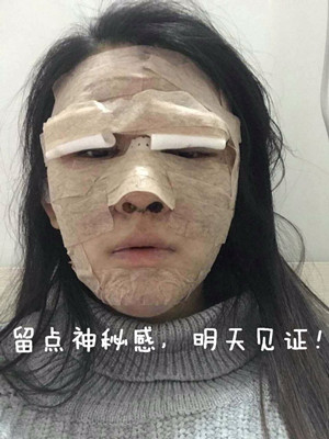 做了詳細(xì)部脂肪填充+雙眼皮+假體隆鼻，來看看果如何