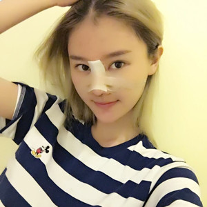 硅膠隆鼻2個(gè)月啦，8000元做的哦!