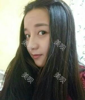 韓式隆鼻整形真實恢復(fù)期圖片，自然不夸張