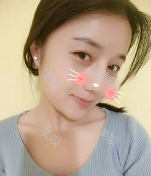 韓式隆鼻整形真實恢復(fù)期圖片，自然不夸張