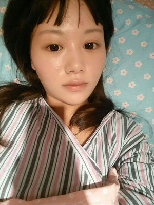 做完自體脂肪豐胸手術(shù)3個(gè)月啦!來(lái)看看前后對(duì)比照片哦