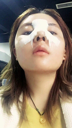 歪鼻矯正+假體隆鼻前后手術(shù)過(guò)程圖片分享