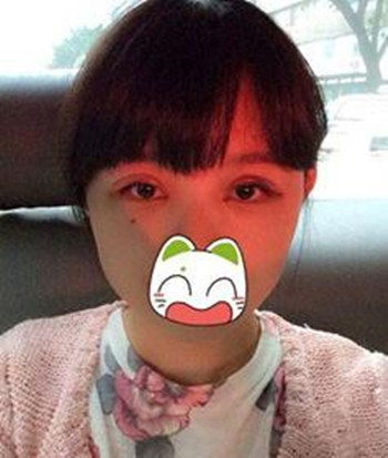 割雙眼皮+開眼角一共8800  快來圍觀我的恢復(fù)經(jīng)歷