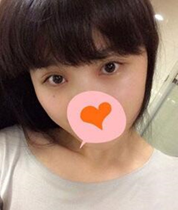 割雙眼皮+開眼角一共8800  快來圍觀我的恢復(fù)經(jīng)歷