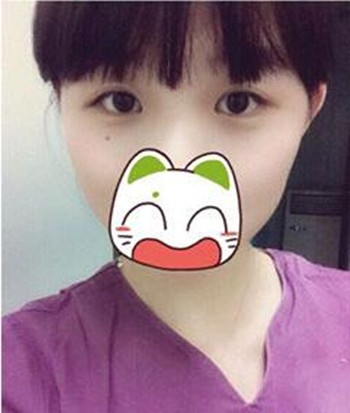 割雙眼皮+開眼角一共8800  快來圍觀我的恢復(fù)經(jīng)歷