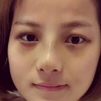 鼻部整形案例和隆鼻前后照片分享