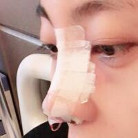 鼻子整形過程恢復(fù)圖片，真實(shí)案例分享