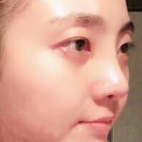 鼻子整形過程恢復(fù)圖片，真實(shí)案例分享