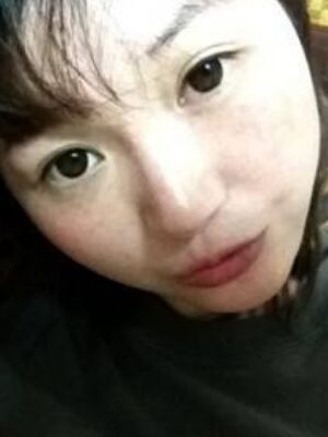 激光去雀斑果好不好，真實案例告訴你