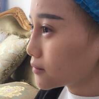 玻尿酸填充臥蠶果對比圖，很滿意