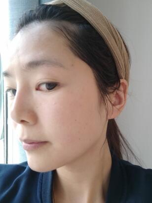 做完光子嫩膚恢復(fù)圖片和過程分享，光子嫩膚價格3800元