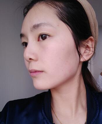 做完光子嫩膚恢復(fù)圖片和過程分享，光子嫩膚價格3800元